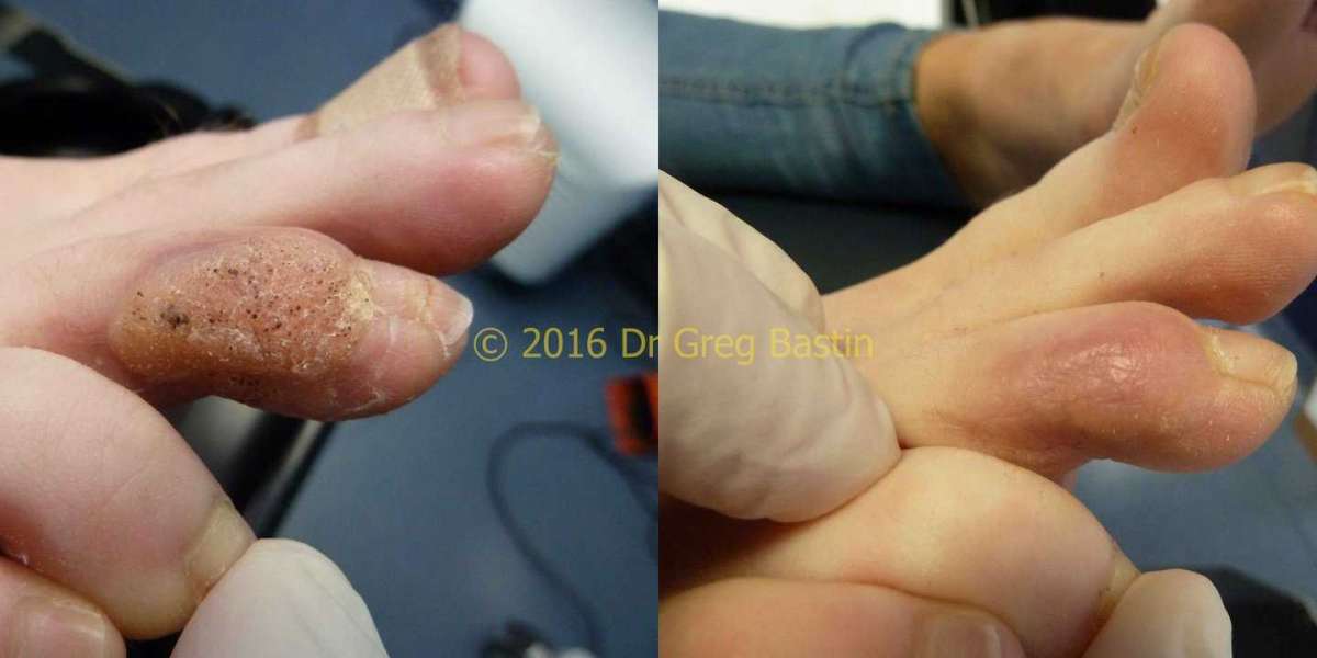 Wart Treatment Methods: Unveiling the Excellence of Laser Surgery.