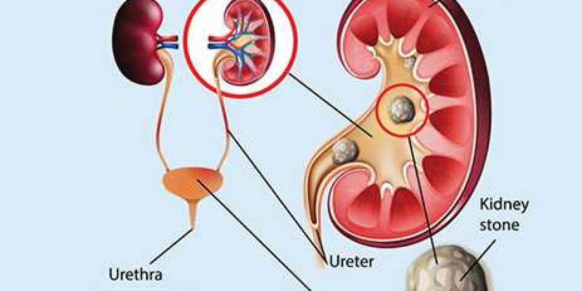 What is the best treatment for kidney stones and what causes?