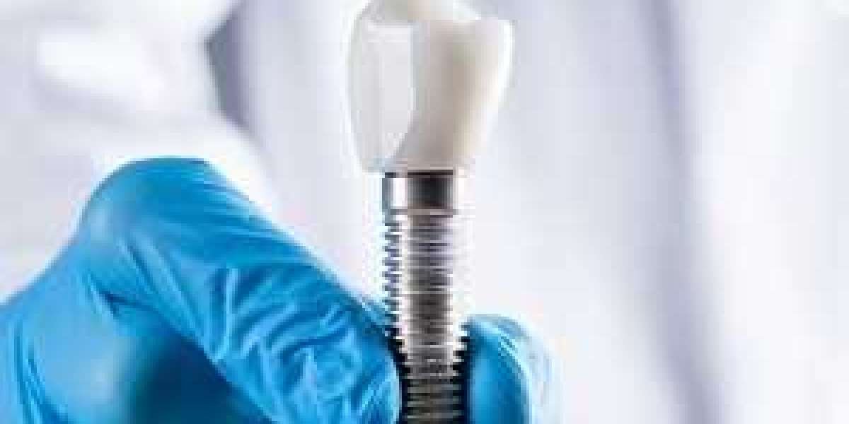 Why Dental Implants Are the Best Thing Since Sliced Bread: A Fun Guide to Getting Your Smile Back