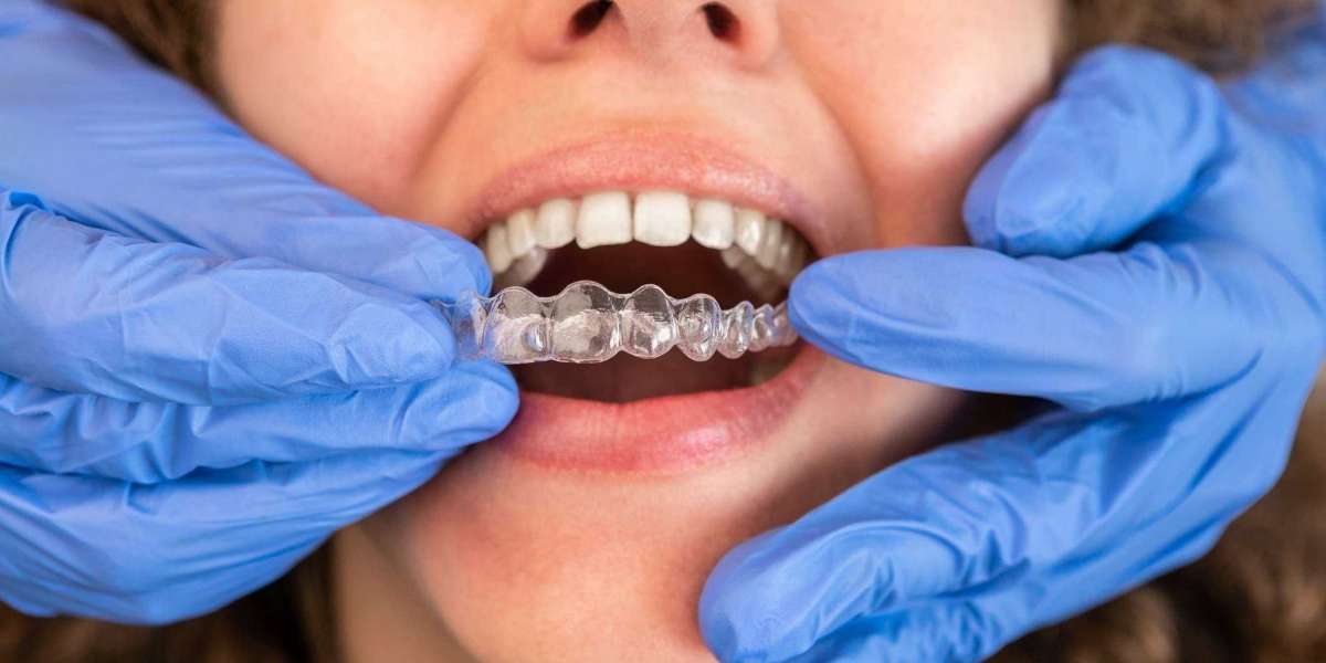 Beyond Braces: How Dentists Are Reshaping Smiles with Invisalign