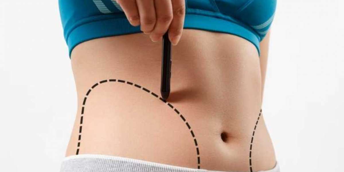 Transform Your Midsection: Tummy Tuck Surgery in Niagara Falls