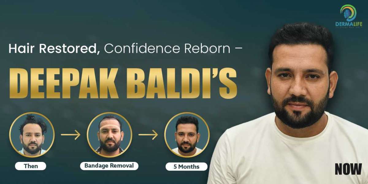 Celebrity Hair Transplant Costs in Delhi: Factors, Techniques, and How to Choose the Right Clinic
