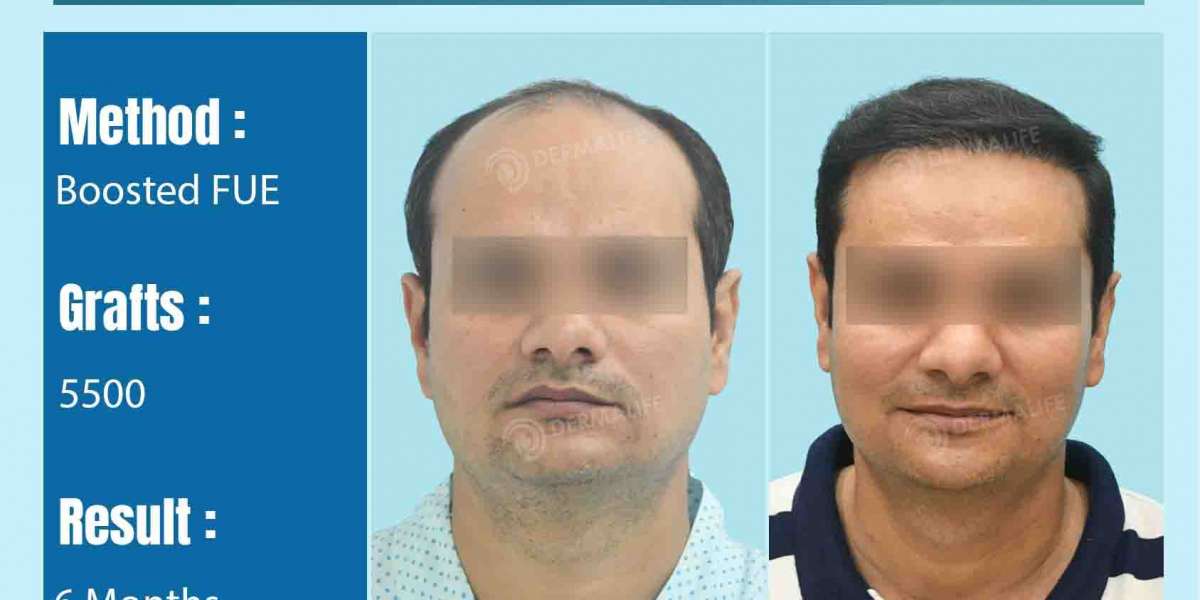 Why Choose Dermalife for the Best Hair Transplant in Delhi?