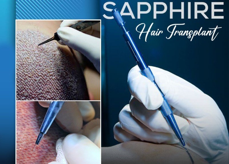 Best Sapphire Hair Transplant in Bangalore | Advanced FUE