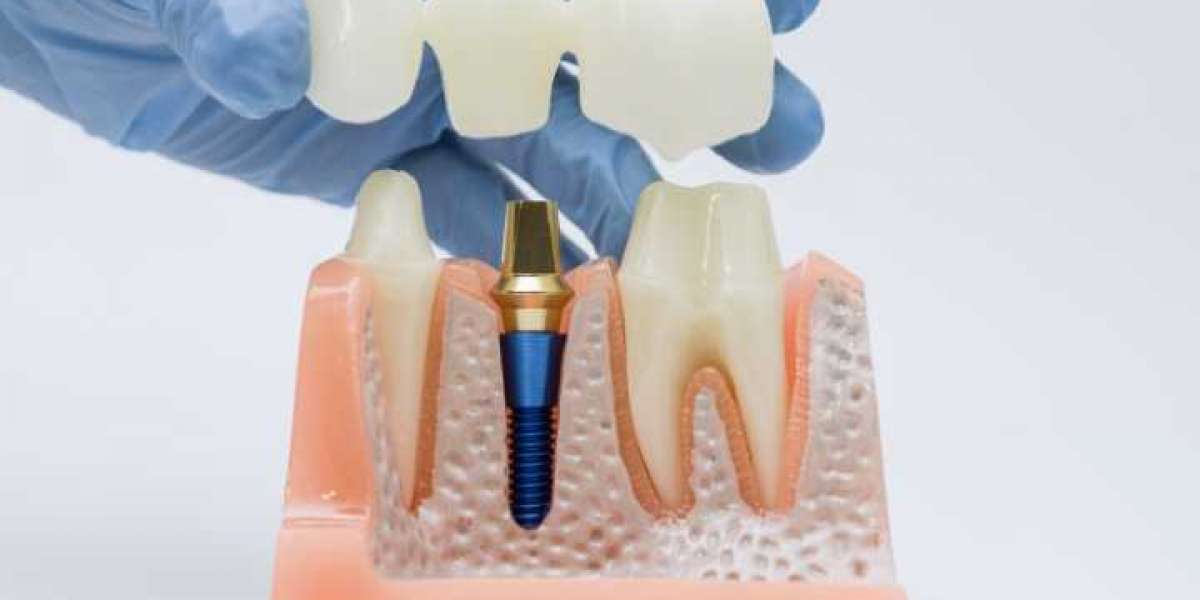 Achieve a Flawless Smile with Modern Dental Veneers