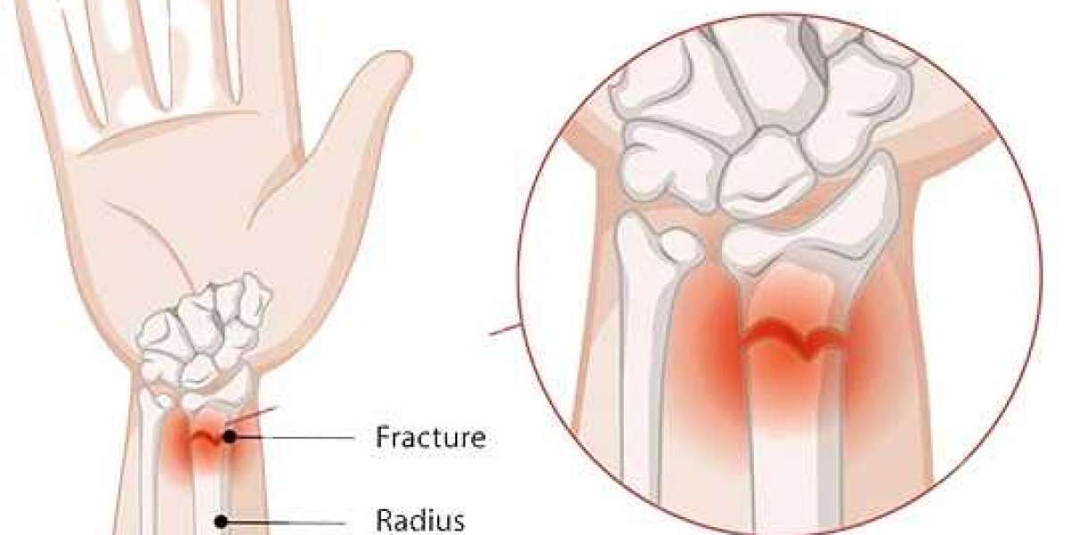When Pain Won’t Go Away: Signs of a Fracture