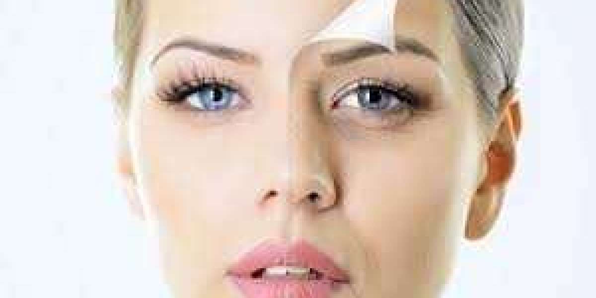 Stretch Marks Treatment and Laser Treatment For Stretch Marks: A Complete Guide