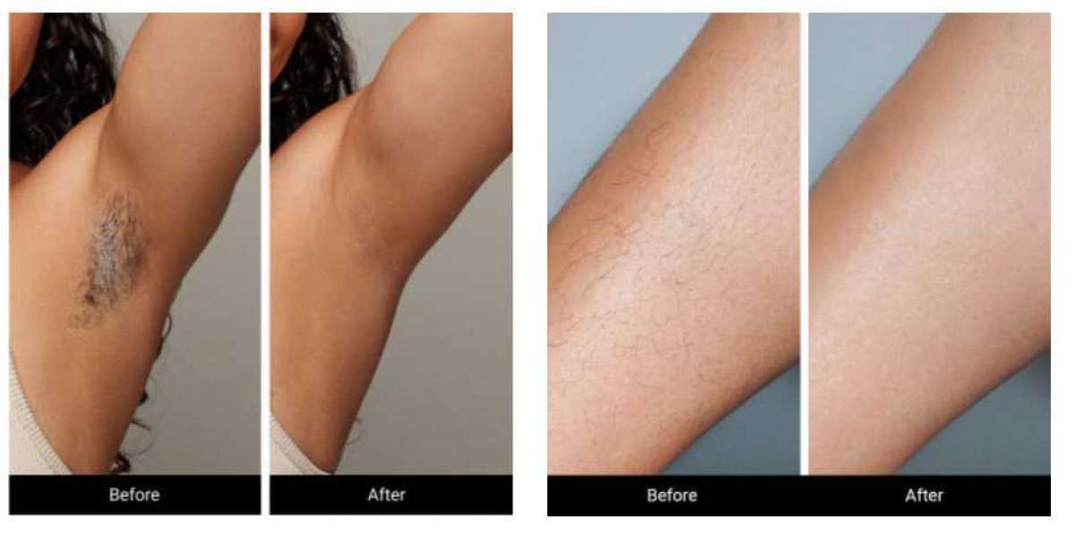 https://www.facebook.com/LoweSkin.Laser.Epilator.Review/